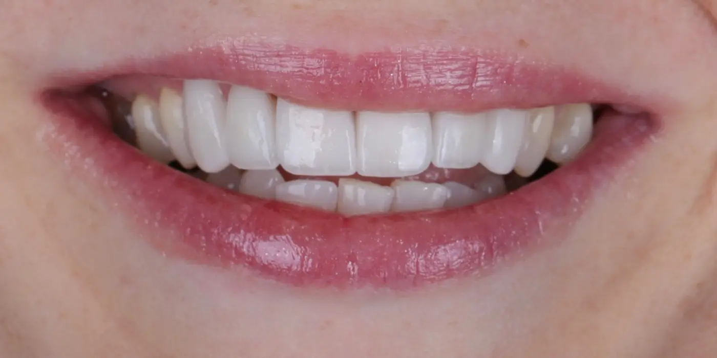 Zähne nach der Versorgung mit e.max® Vollkeramik-Veneers
