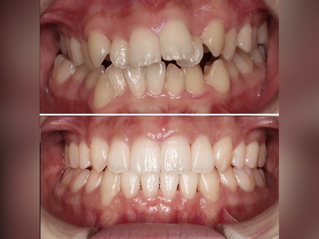 Aligner-Behandlung in der Praxis Dr. Sarmadi, Berlin
